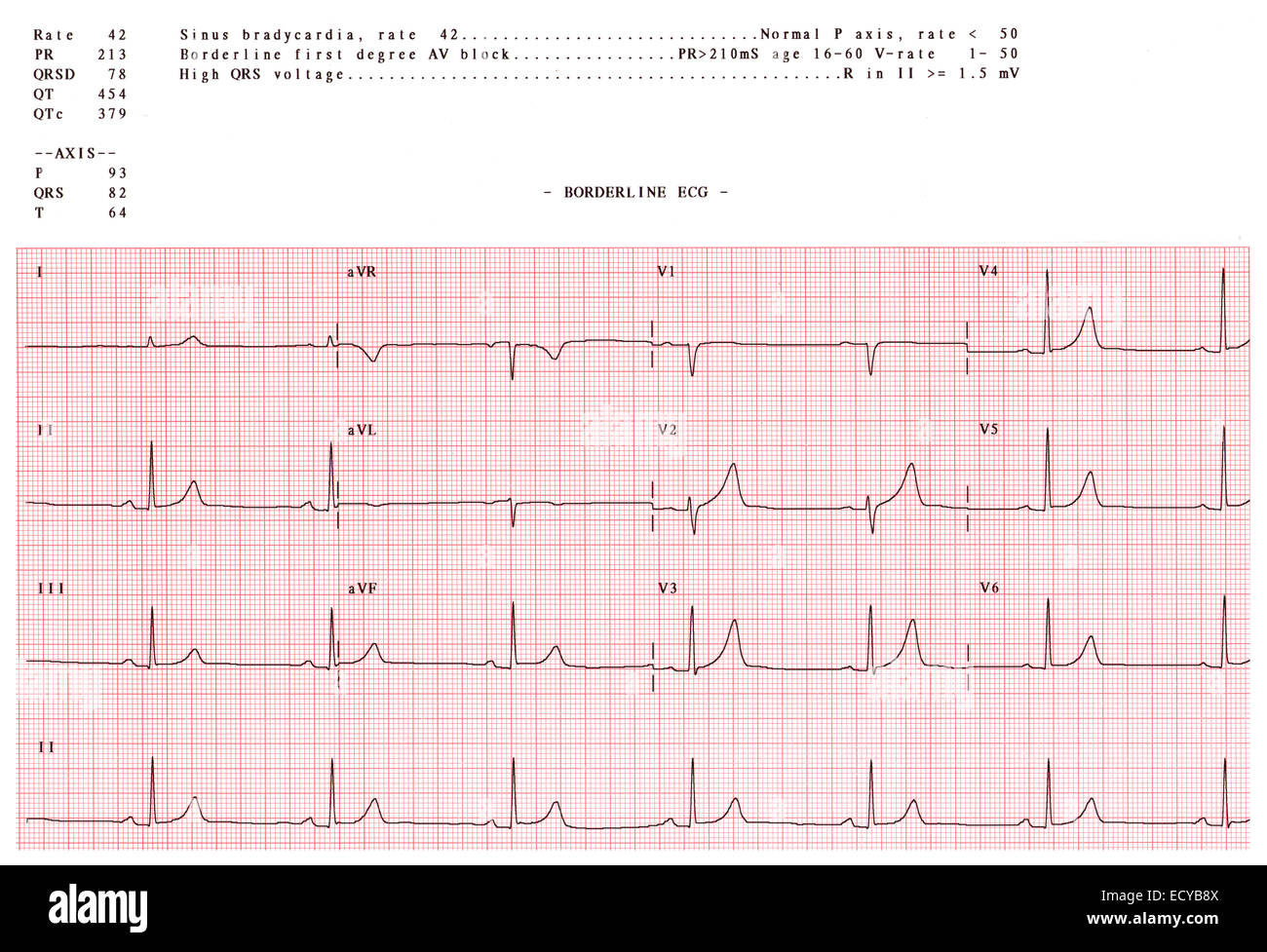 Anormale Elektrokardiogramm zeigt eine Sinus-Bradykardie. Stockfoto