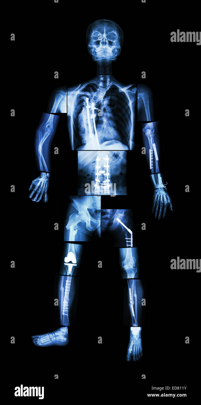 X-ray Ganzkörper und mehrere Frakturen. Er wurde betrieben und interne Fixierung durch Platte & Schraube Stockfoto