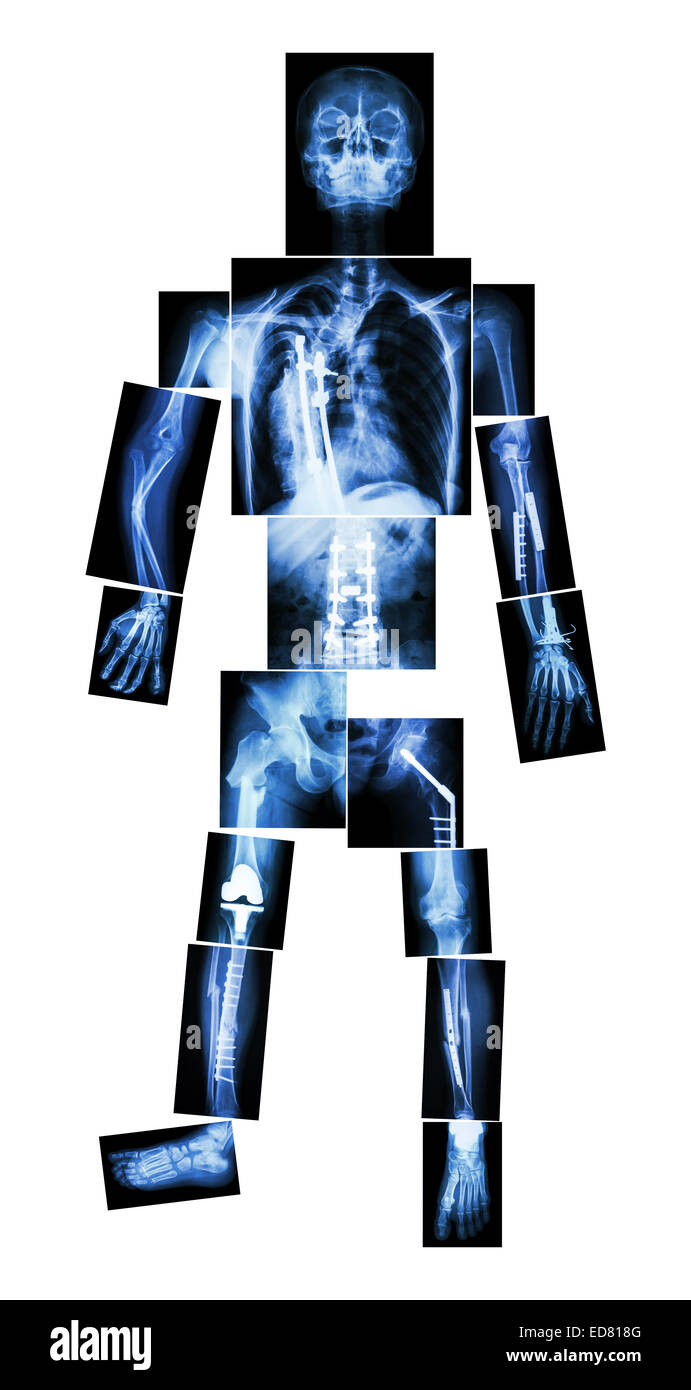 X-ray Ganzkörper und mehrere Frakturen. Er wurde betrieben und interne Fixierung durch Platte & Schraube Stockfoto