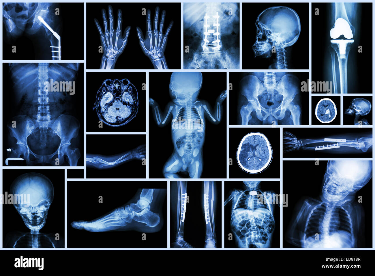 Sammlung mehrerer Röntgen Erwachsenen und des Kindes Orgel & orthopädische Chirurgie & mehrere Krankheiten (Schlaganfall, Arthrose Knie, Fractu Stockfoto