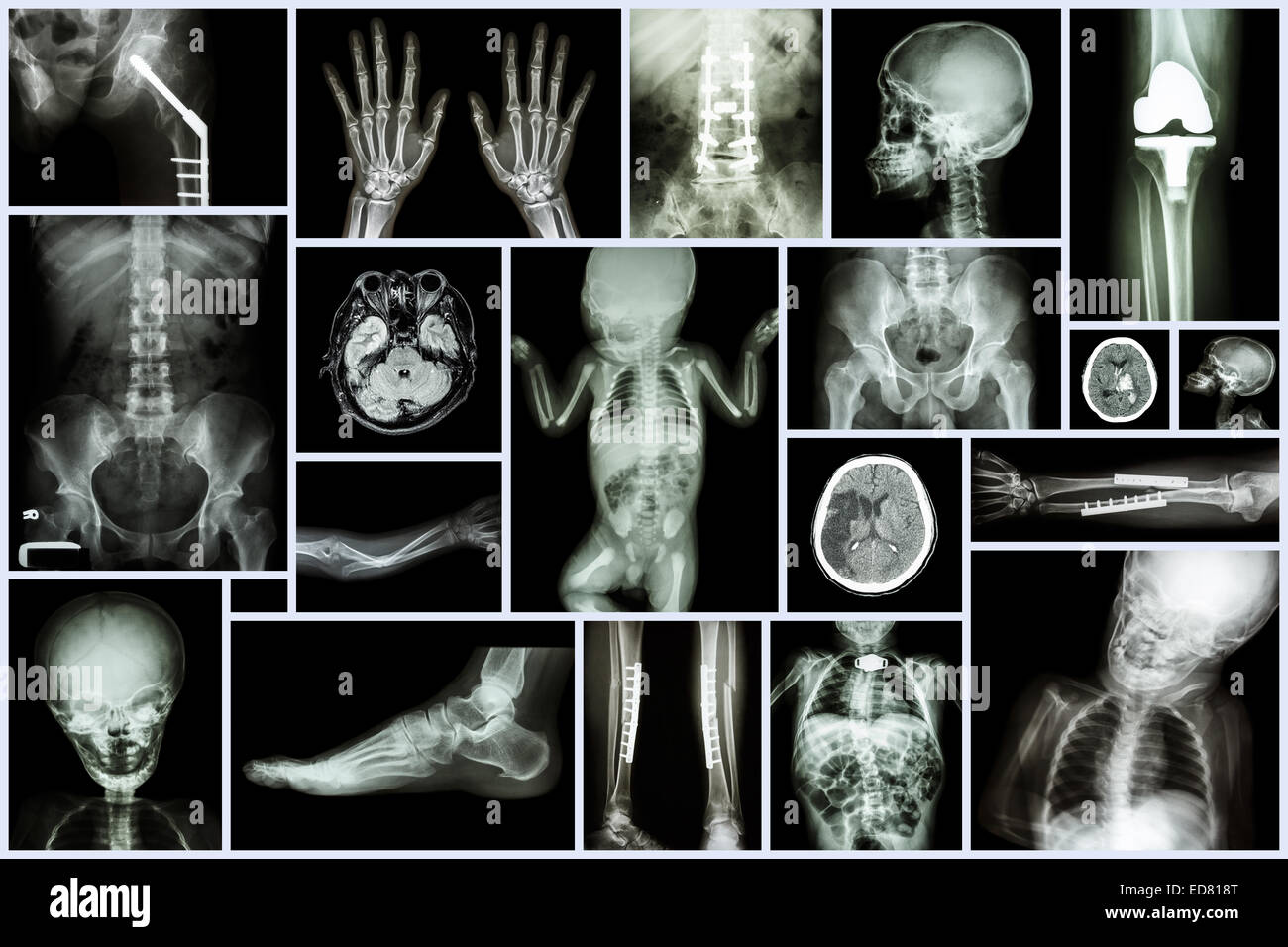 Sammlung mehrerer Röntgen Erwachsenen und des Kindes Orgel & orthopädische Chirurgie & mehrere Krankheiten (Schlaganfall, Arthrose Knie, Fractu Stockfoto