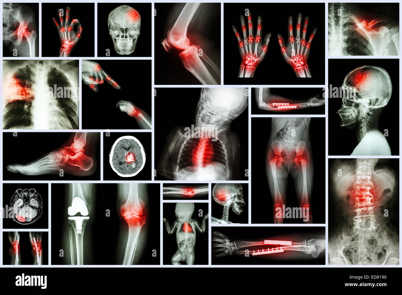 Sammlung Röntgen, mehrere menschliche Organ & orthopädische Chirurgie & mehrere Krankheit (Lungentuberkulose, Gicht, rheumatoide arth Stockfoto