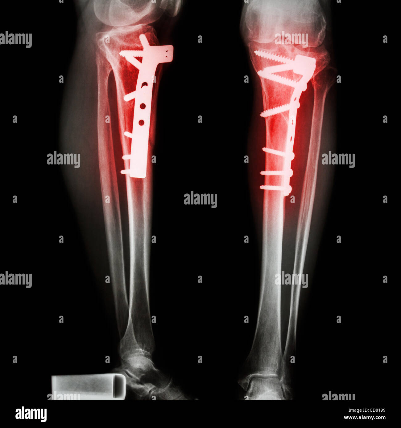 Fraktur Tibia(leg bone). Es wurde operiert und interne festgesetzten Platte & Schraube Stockfoto