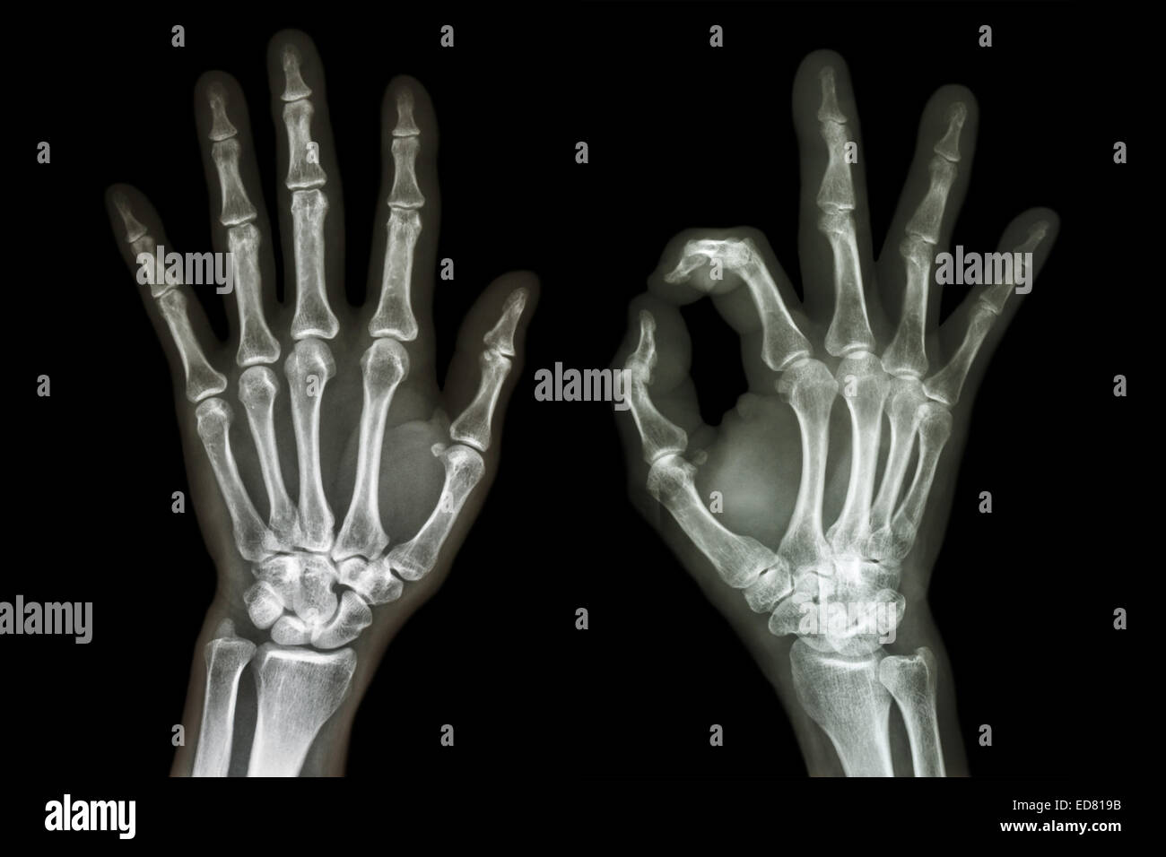 X-ray beide Hände mit OK Sign. Stockfoto