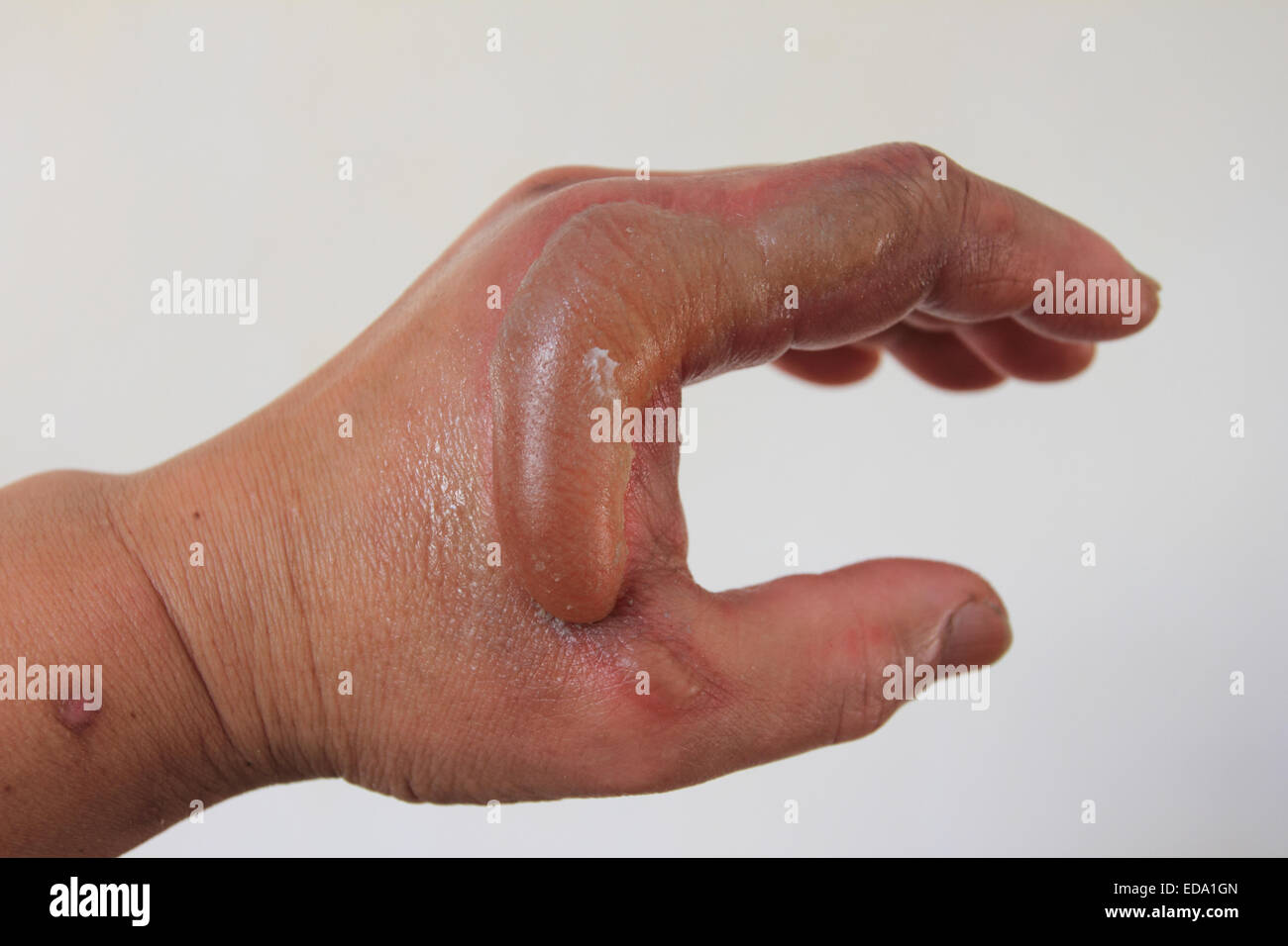 Männliche linke Hand hat Unfall, Verband an der linken Hand, Norfolk, Großbritannien Stockfoto