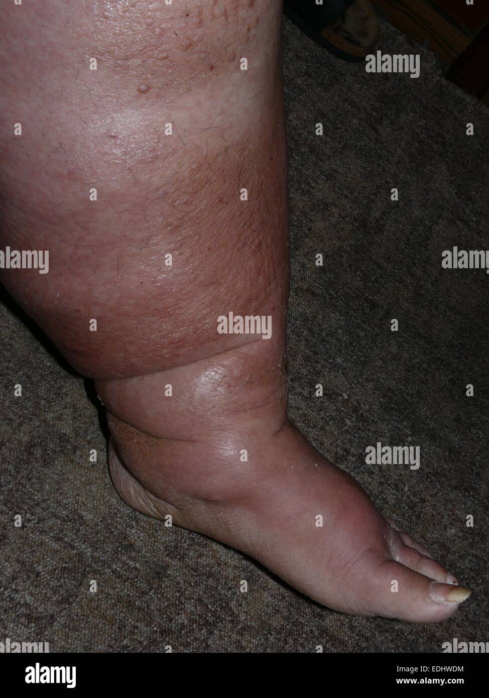 Elephantiasis, Lymphödem oder Lipödem, Bein eine 35 Jahre alte Frau Stockfoto