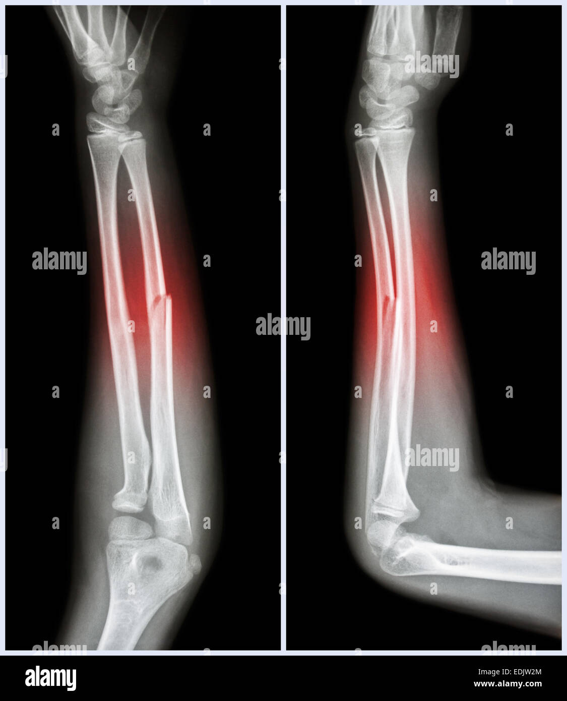 Fraktur-Schaft des ulnaren Bone (Unterarm-Bone): (Front und Seite anzeigen) Stockfoto