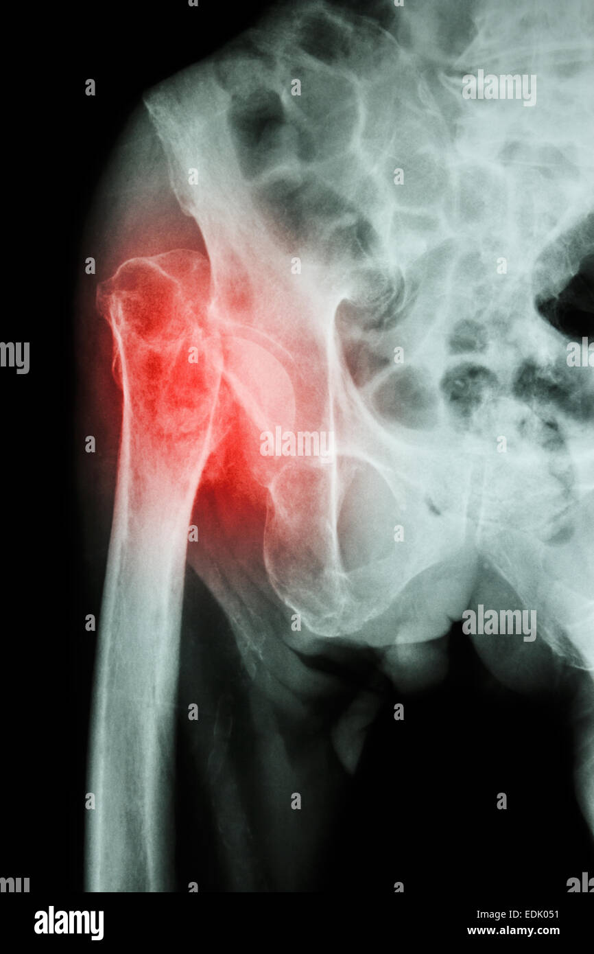 X-ray Becken & Hüftgelenk: Fraktur Kopf des Femur (Oberschenkelknochen) Stockfoto