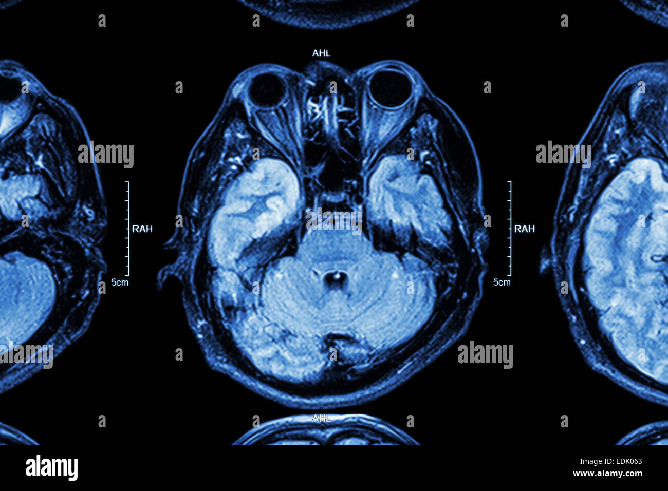 Nahaufnahme von MRI Gehirn: unterer Teil des Gehirns (Augen, Temporallappen Großhirn, Kleinhirn, Hirnstamm) Stockfoto