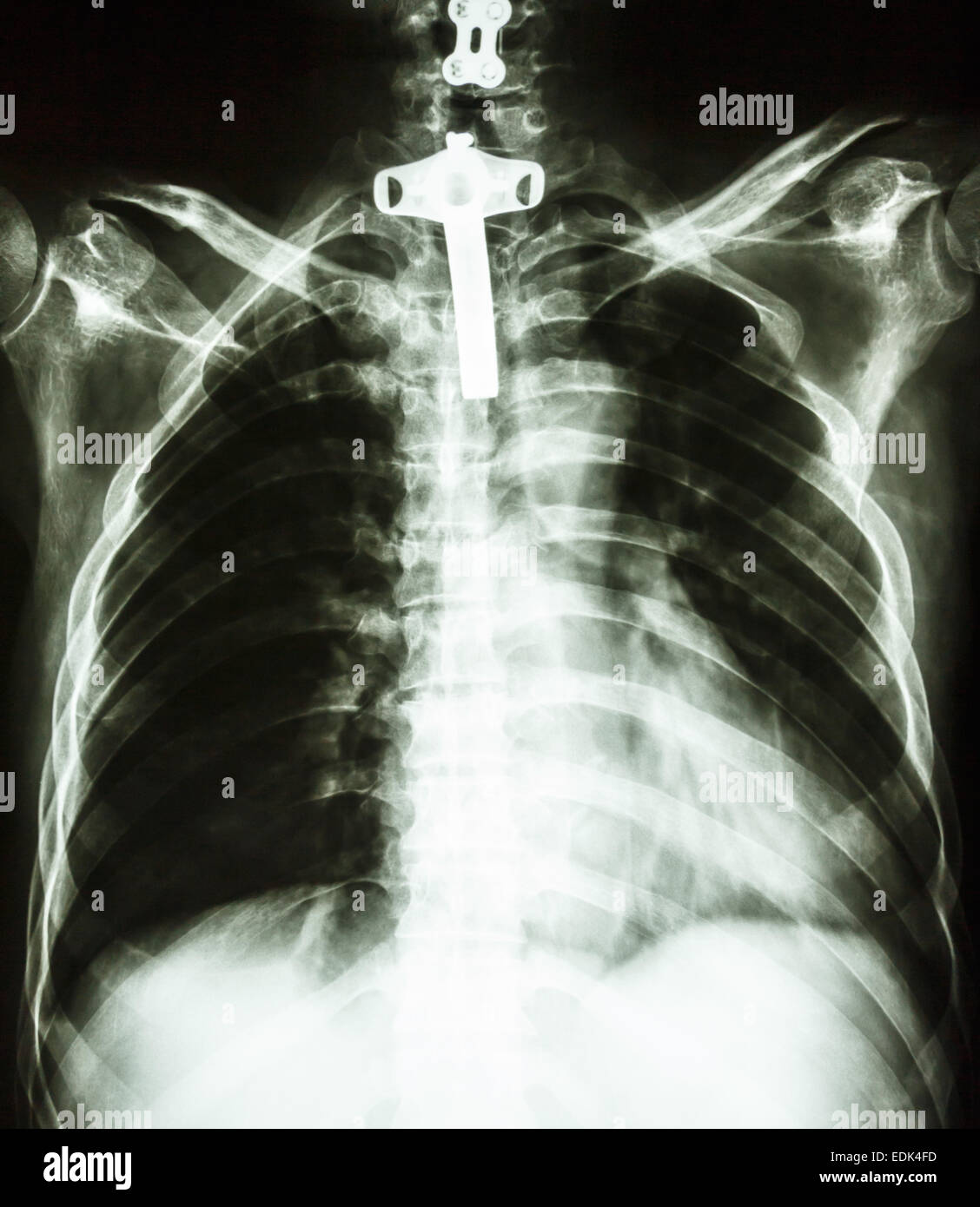 Film Brust Röntgen PA aufrecht: zeigen menschliche Brust mit Tracheotomieschlauch Stockfoto