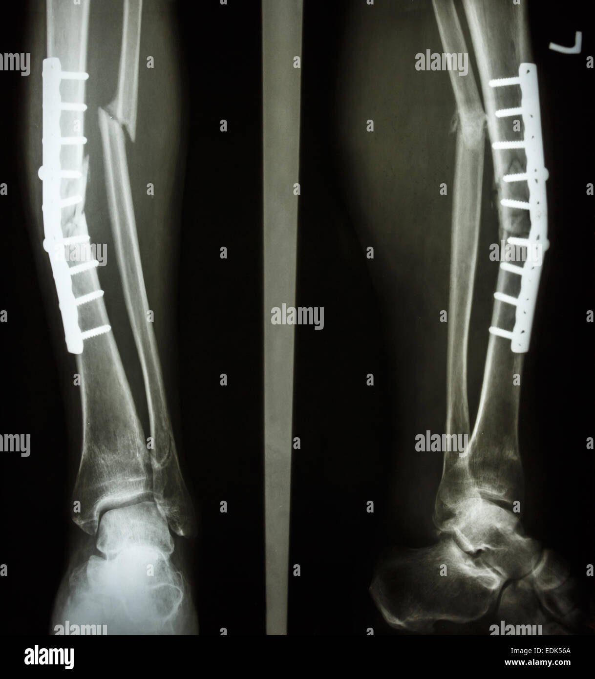 AP/seitliche Bein Film: Fraktur Welle von Tibia und Fibuladefekt (Beinknochen) zu zeigen. Patient wurde operiert und legen Sie die Platte und Schraube für Stockfoto