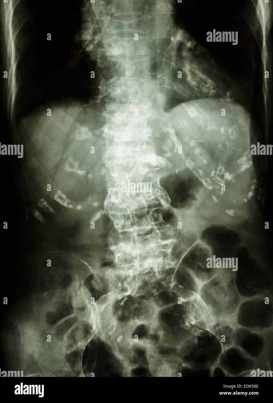 "Spondylose" Film Röntgen Abdomen des alten Alter Menschen: Wirbelsäule mit Sporn und Verkalkungen an mehrere Knochen & Schiffe zeigen Stockfoto