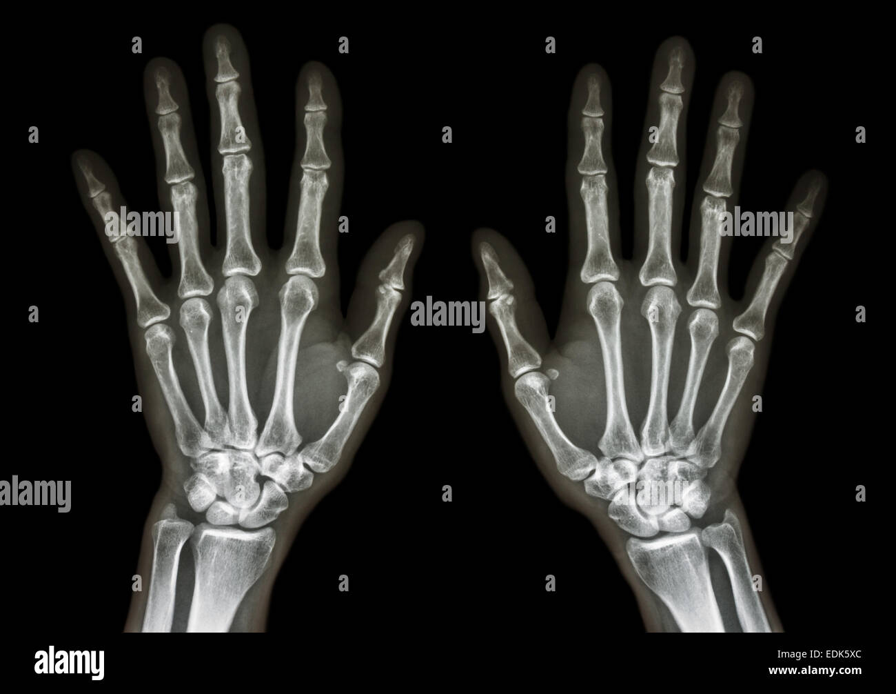 Normal x ray the hand Fotos und Bildmaterial in hoher Auflösung Alamy