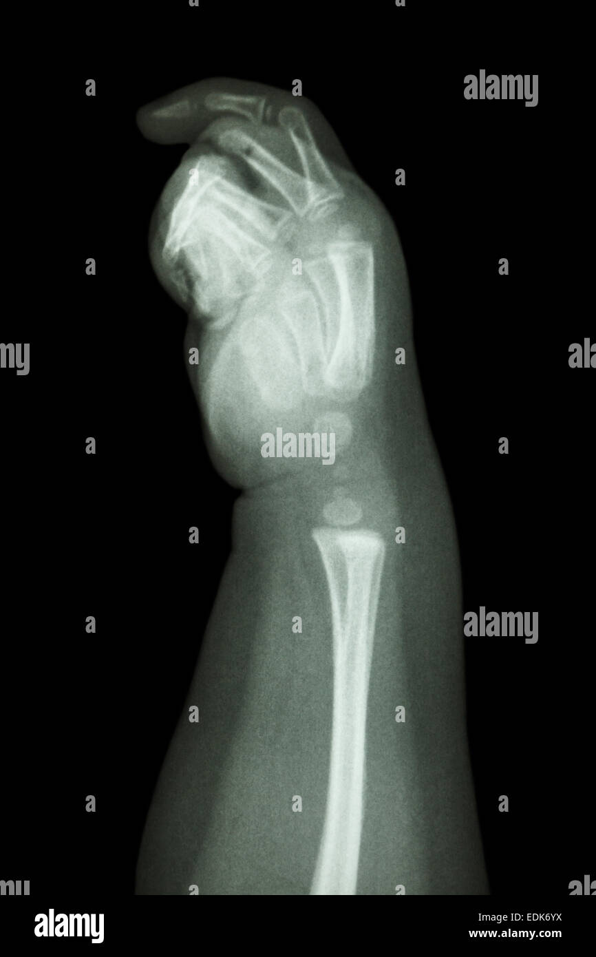 den Film Röntgen Unterarm und Hand: normales Kind Knochen zeigen Stockfoto