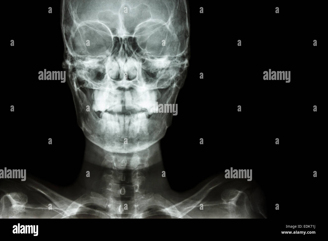 Röntgen Schädel AP Film: normalen menschliches Schädel und leeren Bereich auf der rechten Seite zeigen Stockfoto