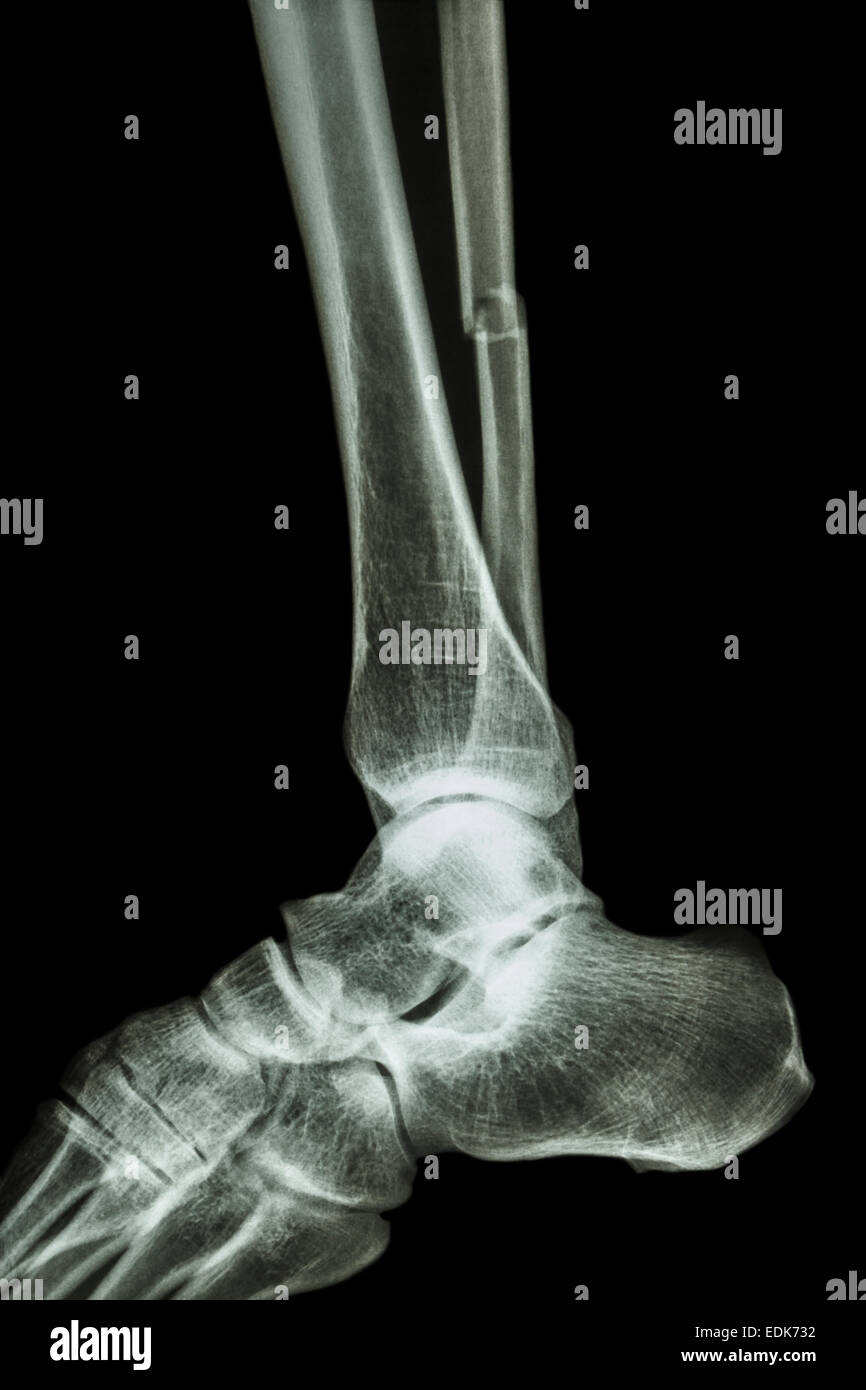 Film x-ray Knöchel seitlichen: zeigen Sie komplette Fraktur Welle Fibula (Beinknochen) Stockfoto