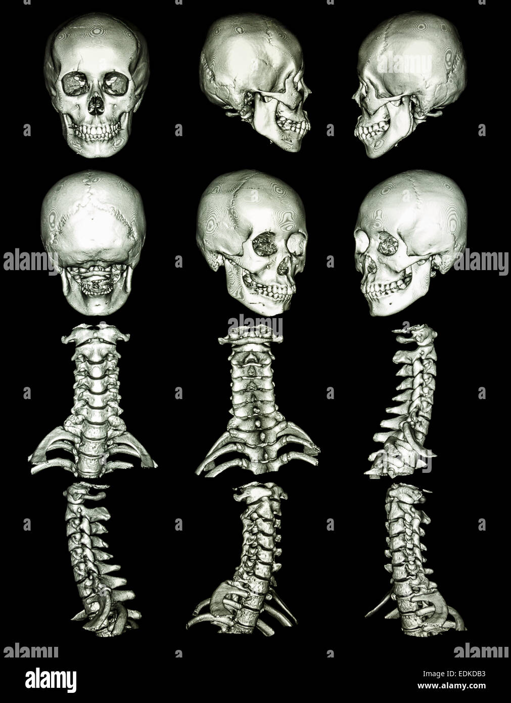 CT-Scan (Computertomographie-Tomographie) mit 3D Grafik zeigen normale menschliche Schädel und Halswirbelsäule Stockfoto