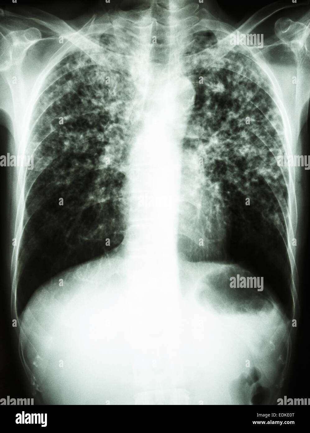 Röntgen der Film interstitielle Infiltrat zeigen beide Lungen durch Mycobacterium-Tuberkulose-Infektion (Lungentuberkulose) Stockfoto