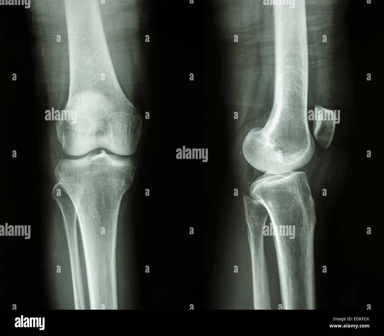 Film Röntgen Knie AP/seitlich: normaler Mensch Knie zeigen Stockfoto