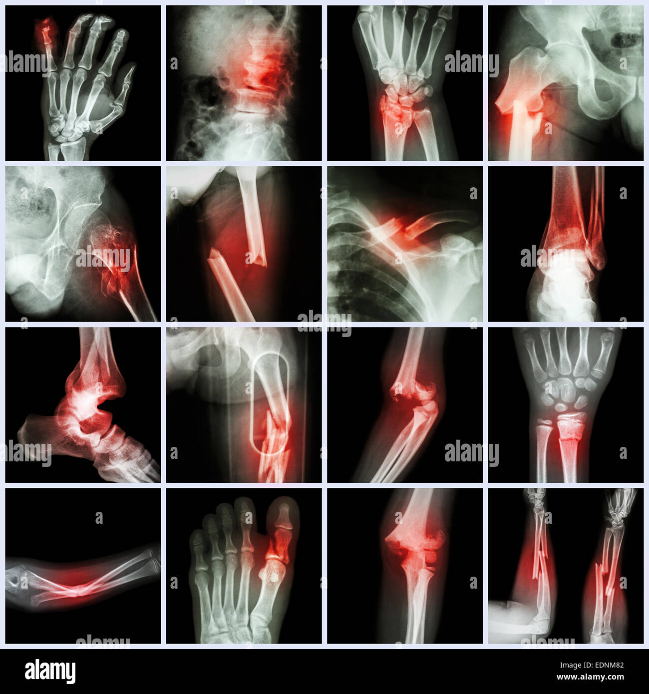 Kollektion Röntgen mehrere Knochenbrüche (Finger, Wirbelsäule, Handgelenk, Hüfte, Bein, Schlüsselbein, Knöchel, Ellenbogen, Arm, Fuß) Stockfoto