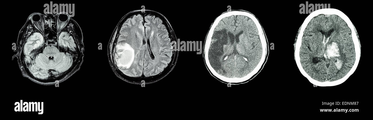 Sammlung-CT-Scan des Gehirns und mehrere Krankheiten (von links nach rechts: normale Gehirn, Hirninfarkt, Hirntumor, Intrazerebrale h Stockfoto