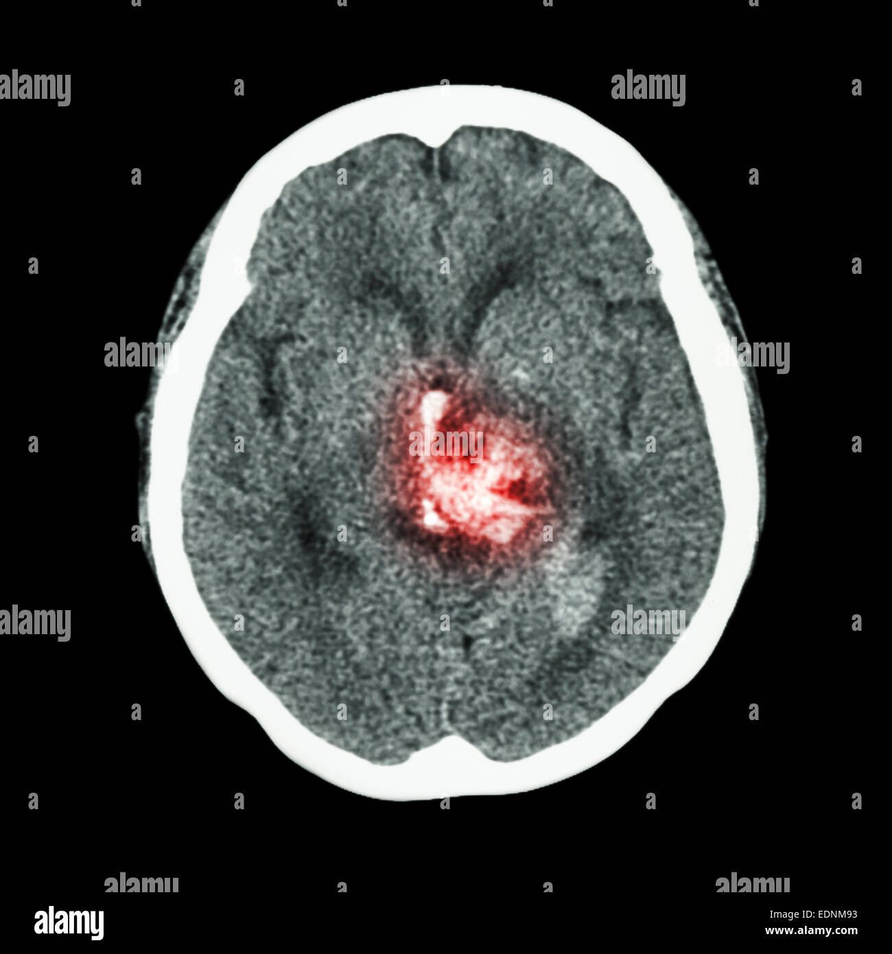 CT-Scan des Gehirns: hämorrhagischen Schlaganfall zeigen Stockfoto
