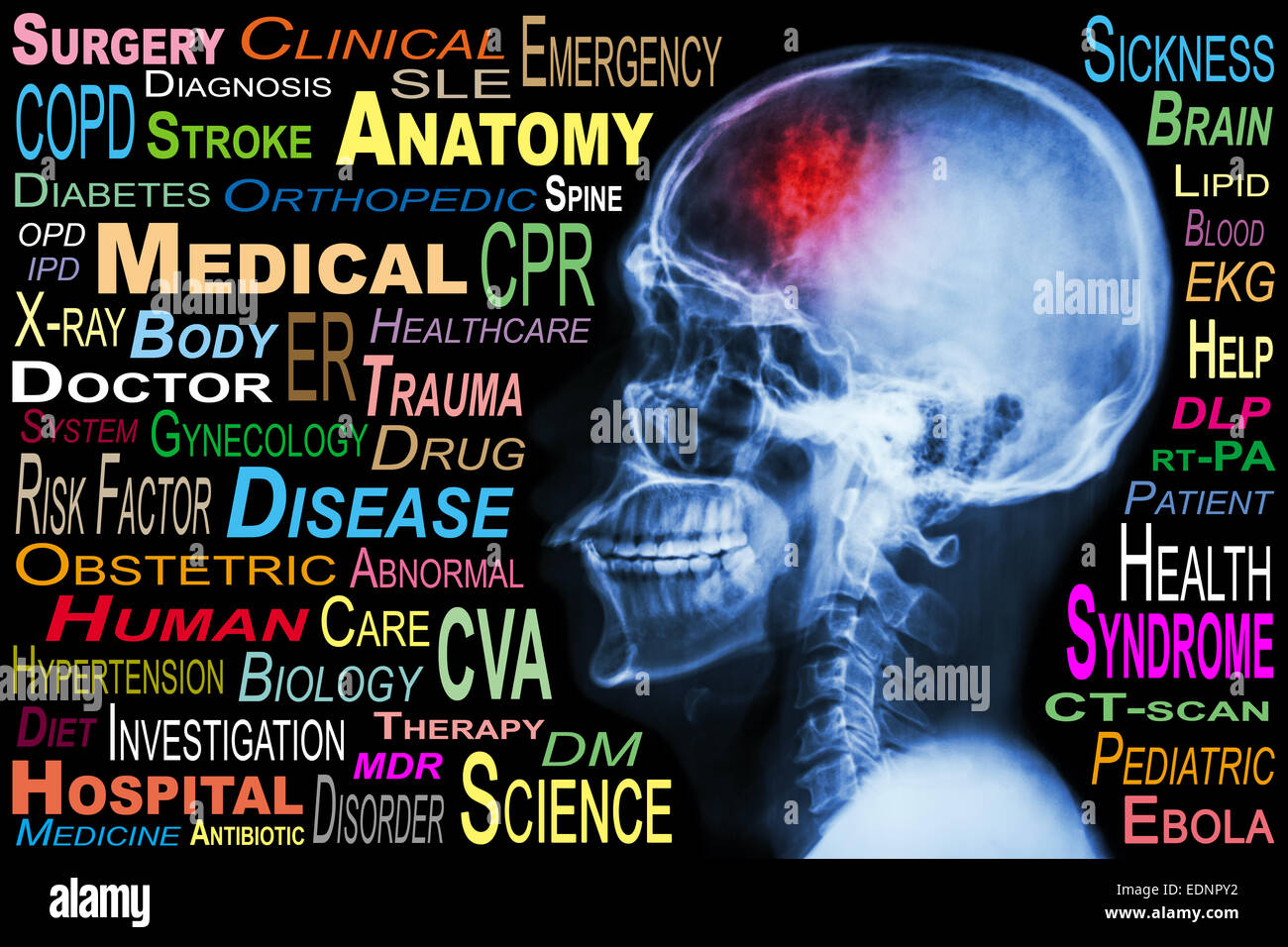 Röntgen Schädel und "Schlaganfall" und Medical Wortwolke Stockfoto