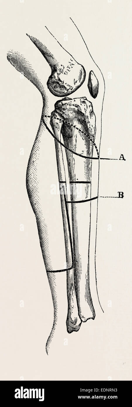 Desartikulation Isarticulation, Medizintechnik, chirurgische Instrumente, Geschichte der Medizin Stockfoto