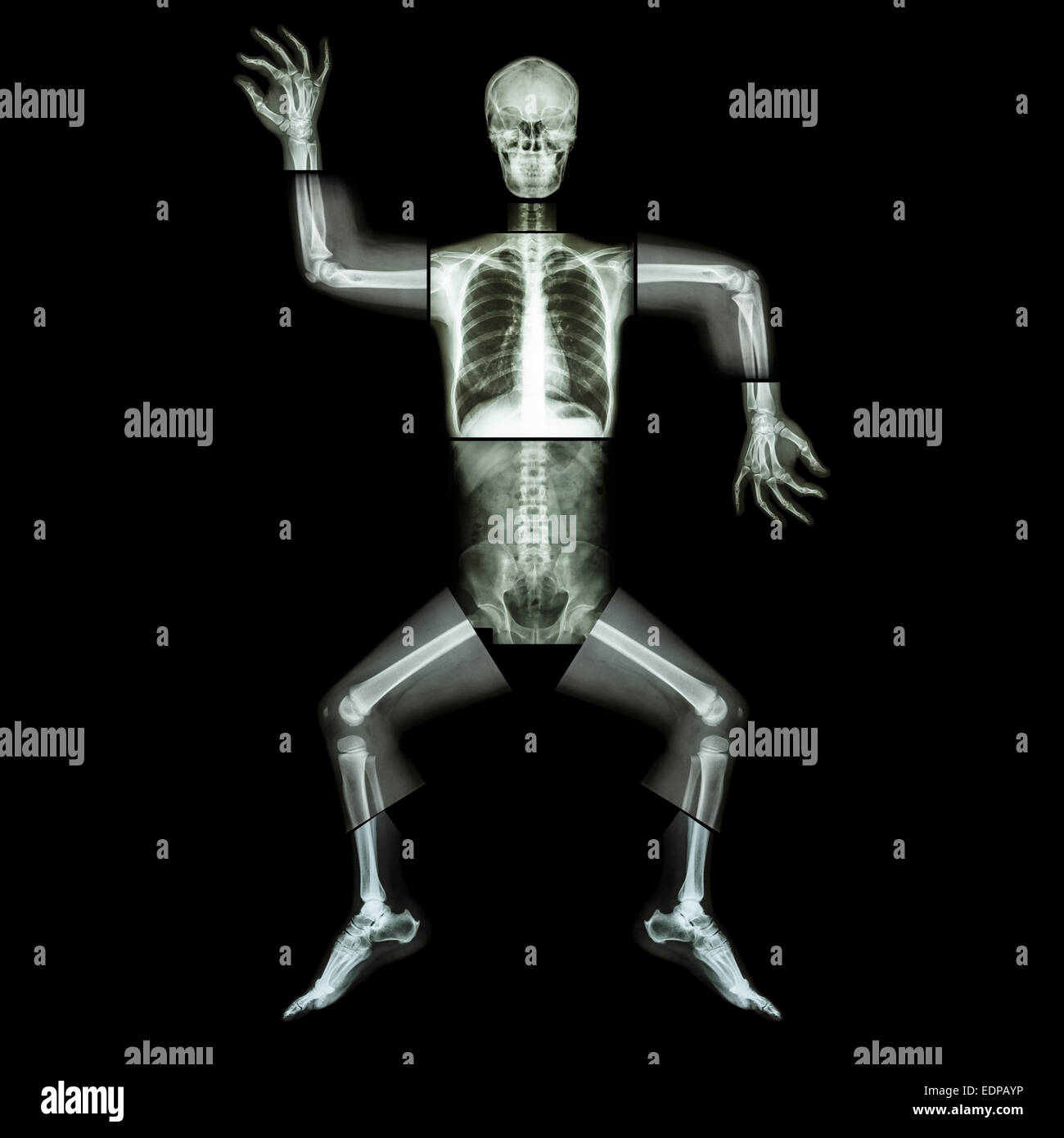 Aerobic Dance (menschliche Knochen tanzt), (Ganzkörper Röntgen: Kopf, Hals, Brust, Schulter, Arm, Ellenbogen, Unterarm, Hand, Finger, gemeinsame Stockfoto