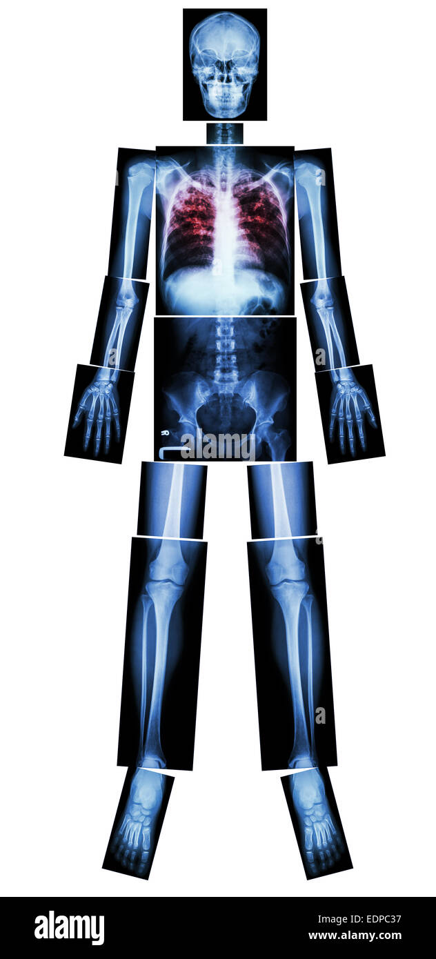 Pulmonale Tuberculosis(TB) (x-ray Ganzkörper: Kopf Schädel Hals Wirbelsäule Schulter Arm Ellenbogen Unterarm Handgelenk Hand Finger Thorax Brust er Stockfoto