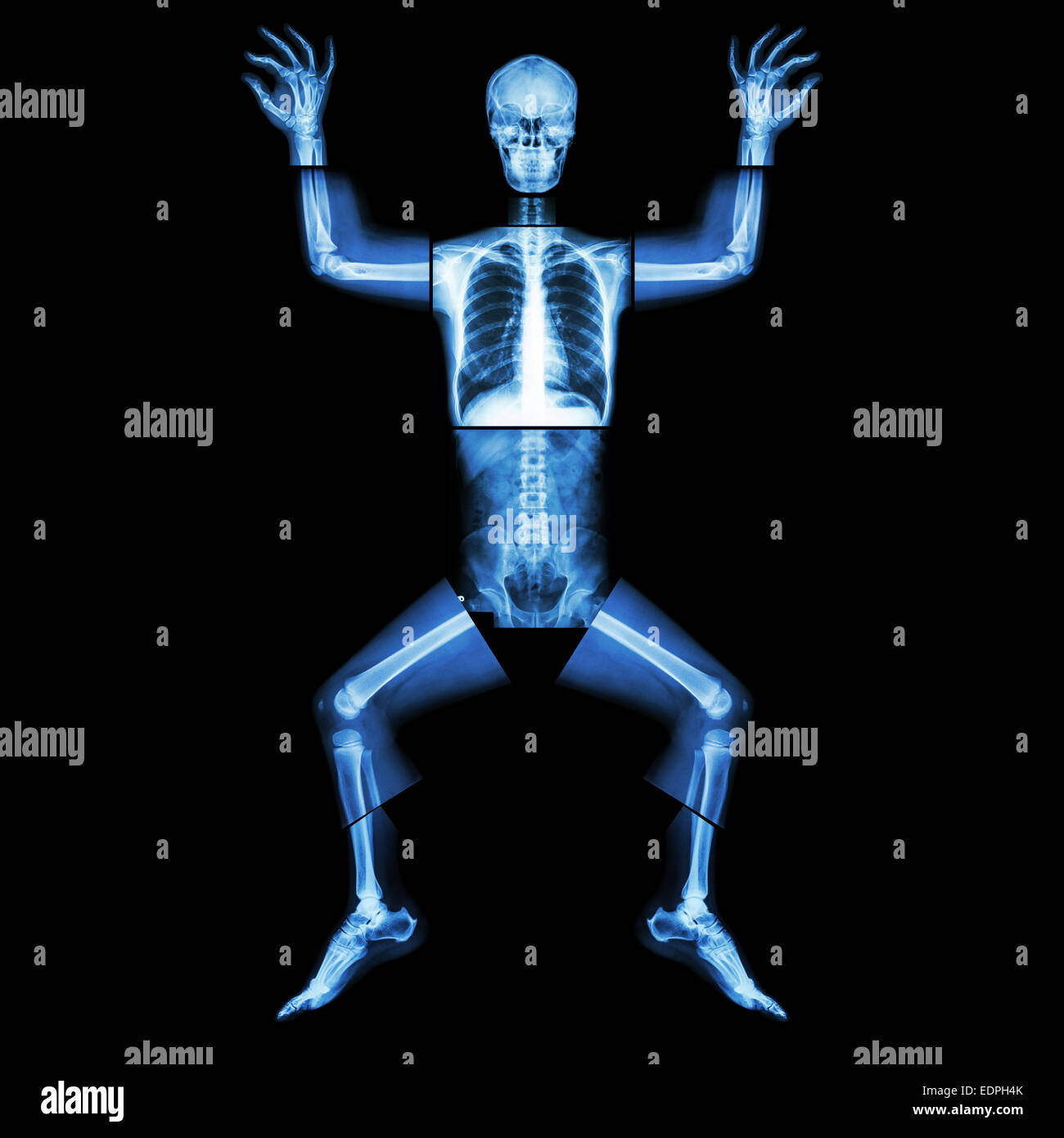 Puzzle Mensch Röntgen (ganzer Körper: Kopf Schädel Gesicht Hals Wirbelsäule Schulter Arm Ellenbogen gemeinsame Unterarm Handgelenk Hand Finger Brust Thorax Hea Stockfoto