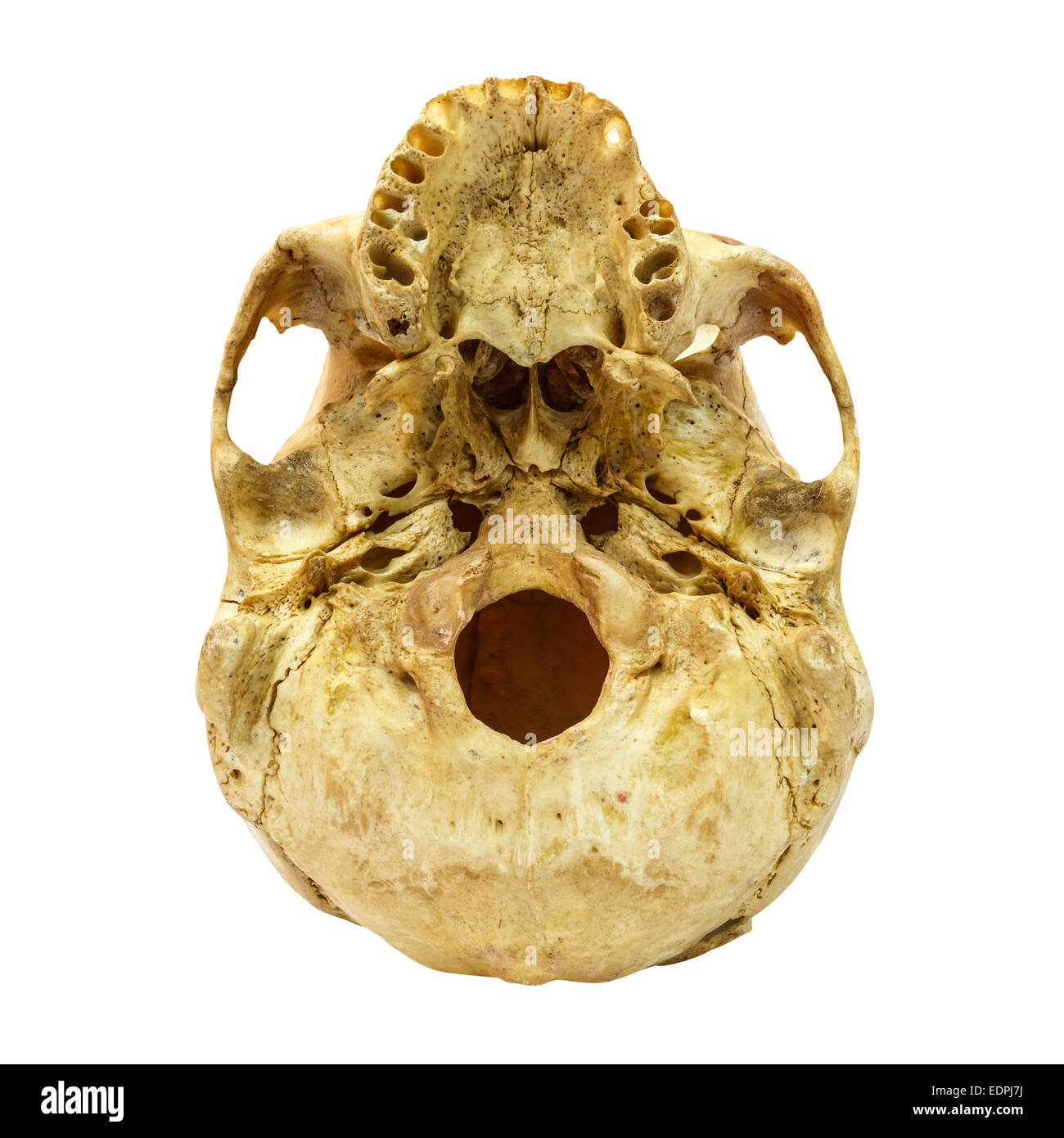 Menschliche Schädel-Fracture(beneath) (Mongoloid, asiatisch) auf isolierte Hintergrund Stockfoto