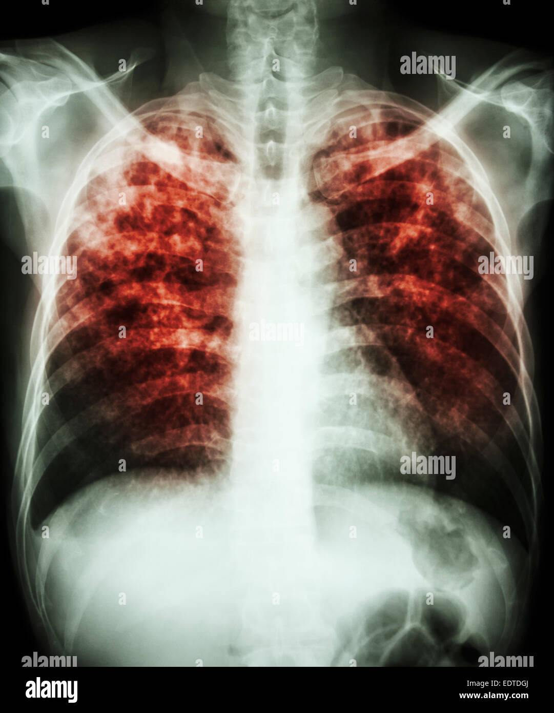 Film "Lungentuberkulose" Röntgen-Thorax zeigen interstitielle Infiltration beider Lunge durch Mycobacterium-Tuberkulose-Infektion Stockfoto