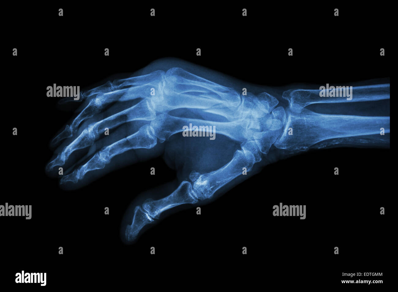 X-ray Hand schrägen Film: Fraktur am 3. und 4. Mittelhandknochen Stockfoto