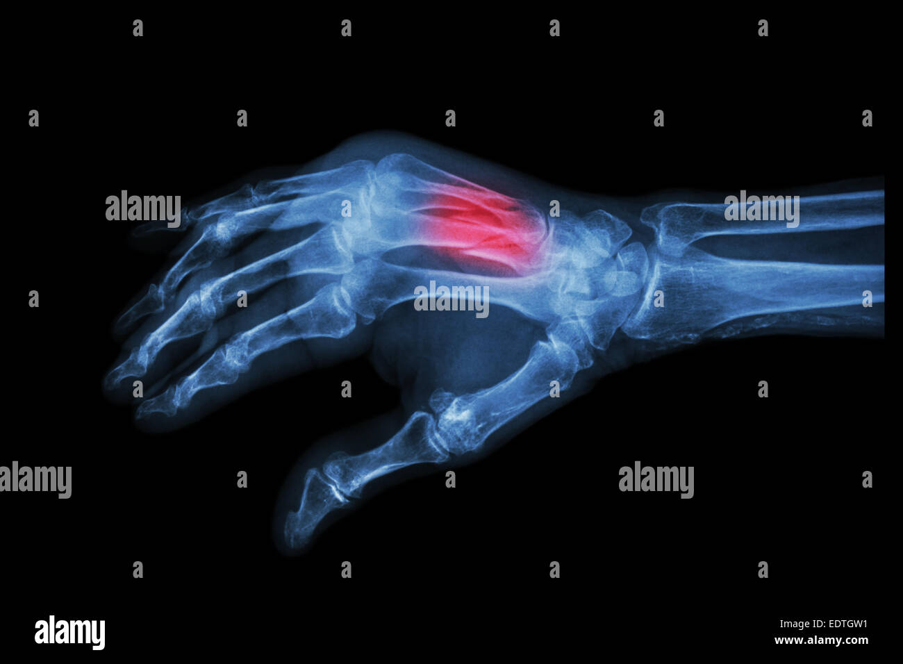 X-ray Hand schrägen Film: Fraktur am 3. und 4. Mittelhandknochen Stockfoto