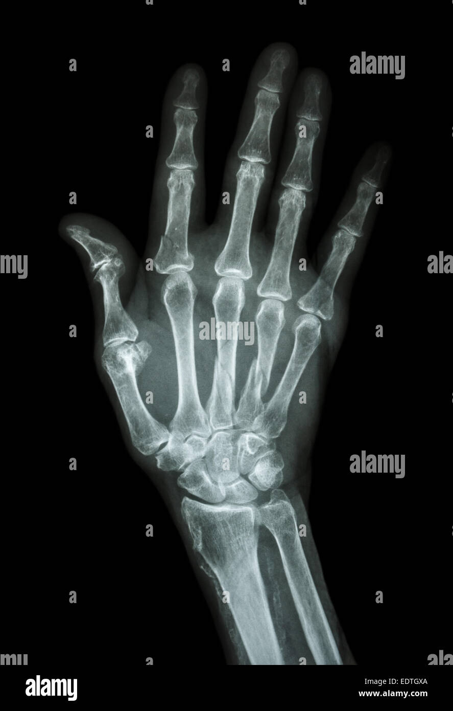 Mehrere Frakturen am Index, kleinen Finger, Mittelhandknochen Stockfoto