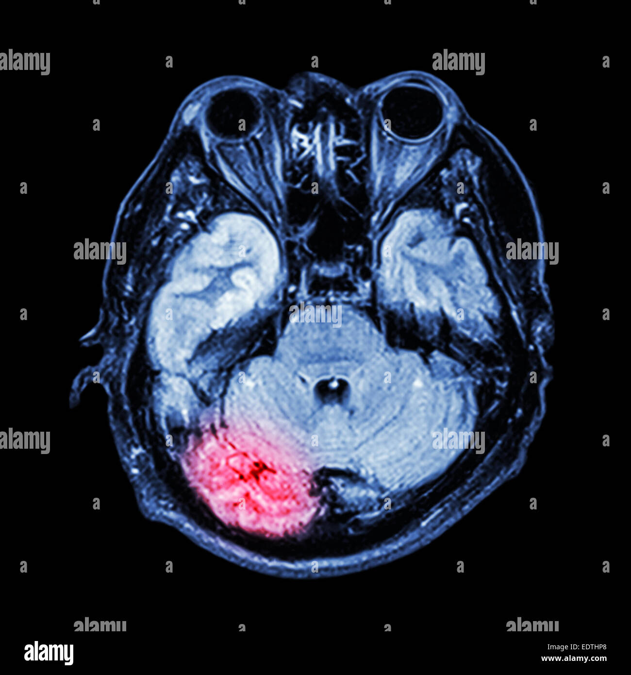 Hirn-Trauma, Schlaganfall (MRI Gehirn) Stockfoto