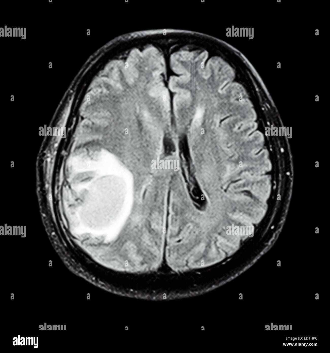 MRI Gehirn: show Gehirntumor im rechten Parietallappen des Großhirns Stockfoto