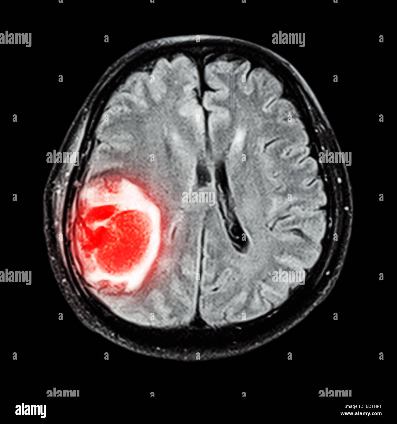 MRI Gehirn: show Gehirntumor im rechten Parietallappen des Großhirns Stockfoto