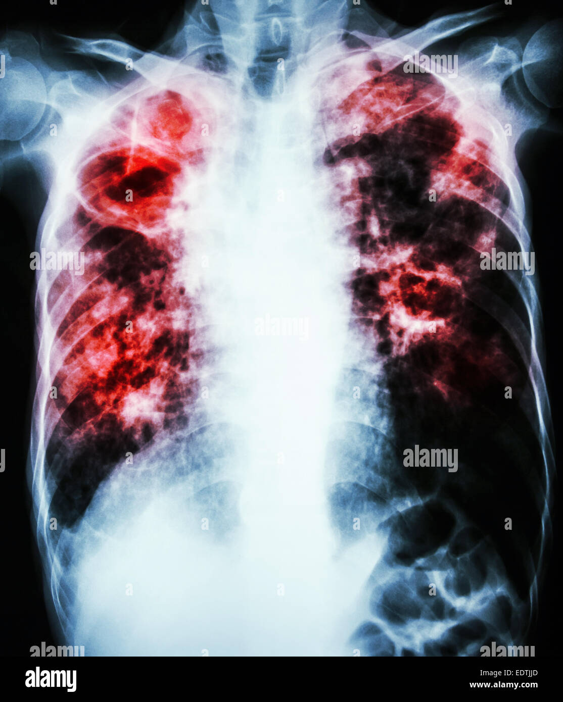 Röntgen der Film zeigen Hohlraum im rechten Lungenflügel, Fibrose & interstitielle & lückenhaft Infiltrat in beiden Lungen durch Mycobacterium tubercu Stockfoto