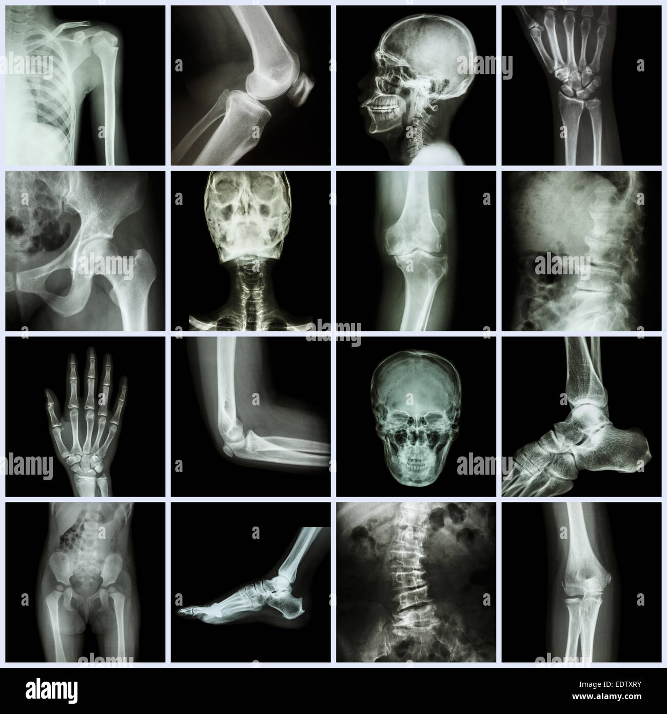 Sammlung menschlichen Gelenk (Schädel Kopf Hals Schulter Brust Thorax Schulter Arm Ellenbogen Unterarm Handgelenk Hand Finger Palm Wirbelsäule Rücken pelv Stockfoto