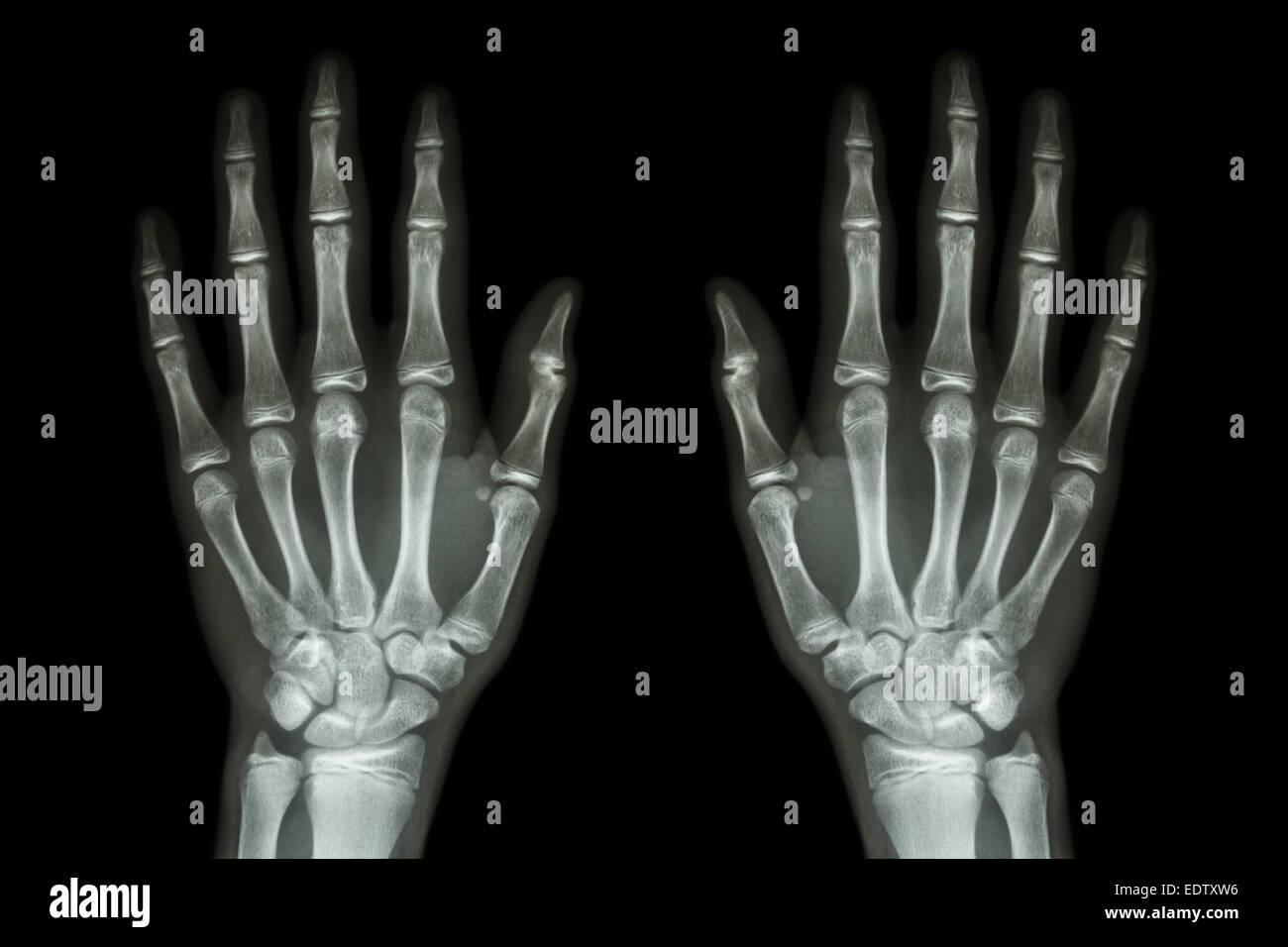 X-ray normale menschliche Hände (vorne) auf schwarzem Hintergrund Stockfoto