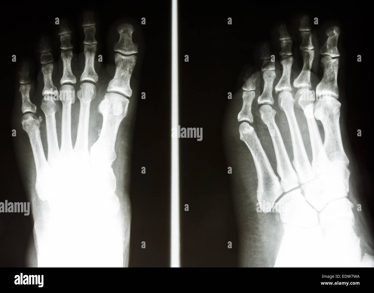 x-ray Film zeigen normalen Knochen des menschlichen Fußes Stockfoto