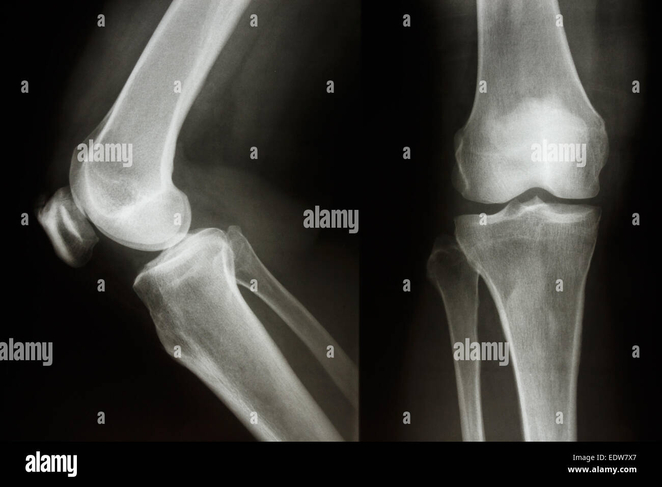 Der Roentgenfilm zeigen normale Knie joint(AP/Lateral) Stockfoto