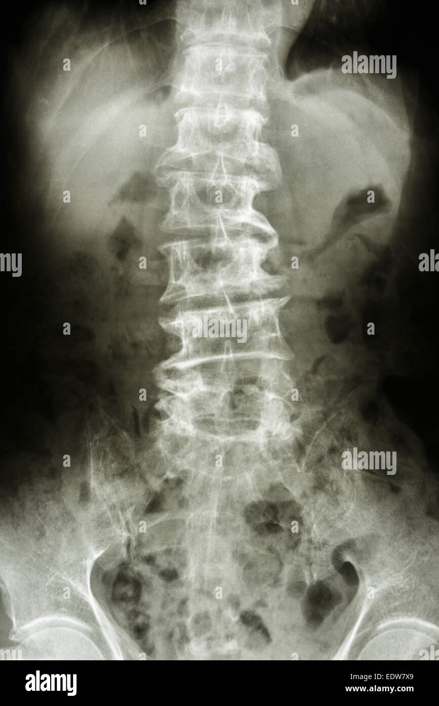 Film x-ray Show gebogen, Lendenwirbelsäule und Ausläufer der alten Menschen (Spondylose Patient), (Wirbelsäule) Stockfoto