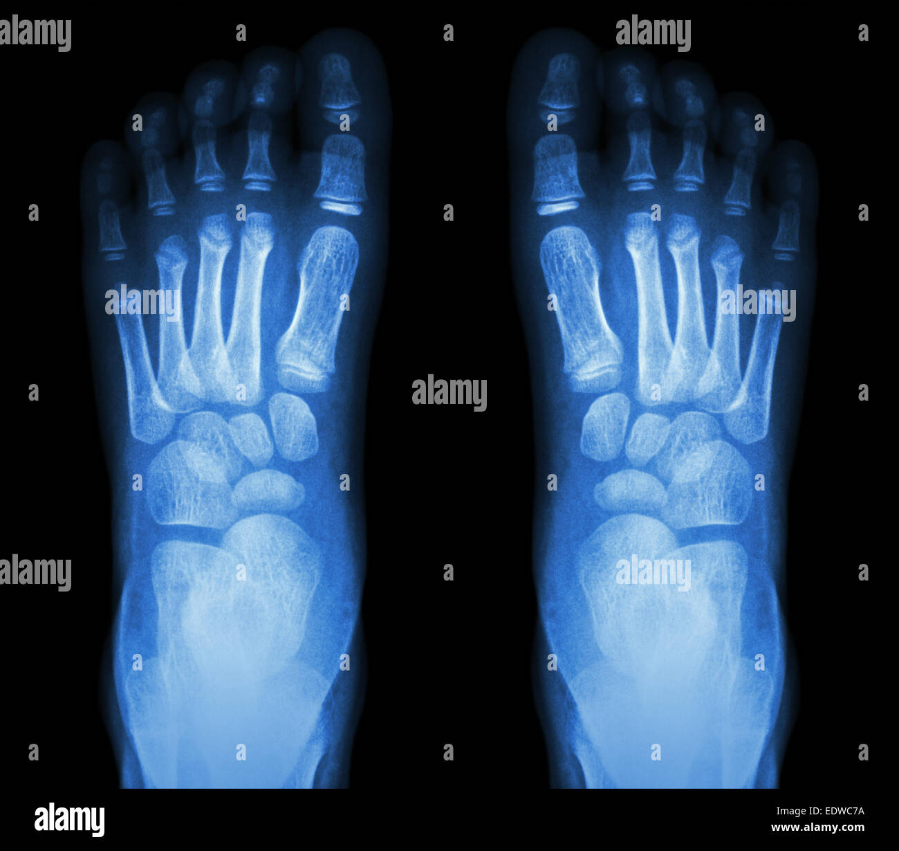 X-ray normalen Kindes foots Stockfoto