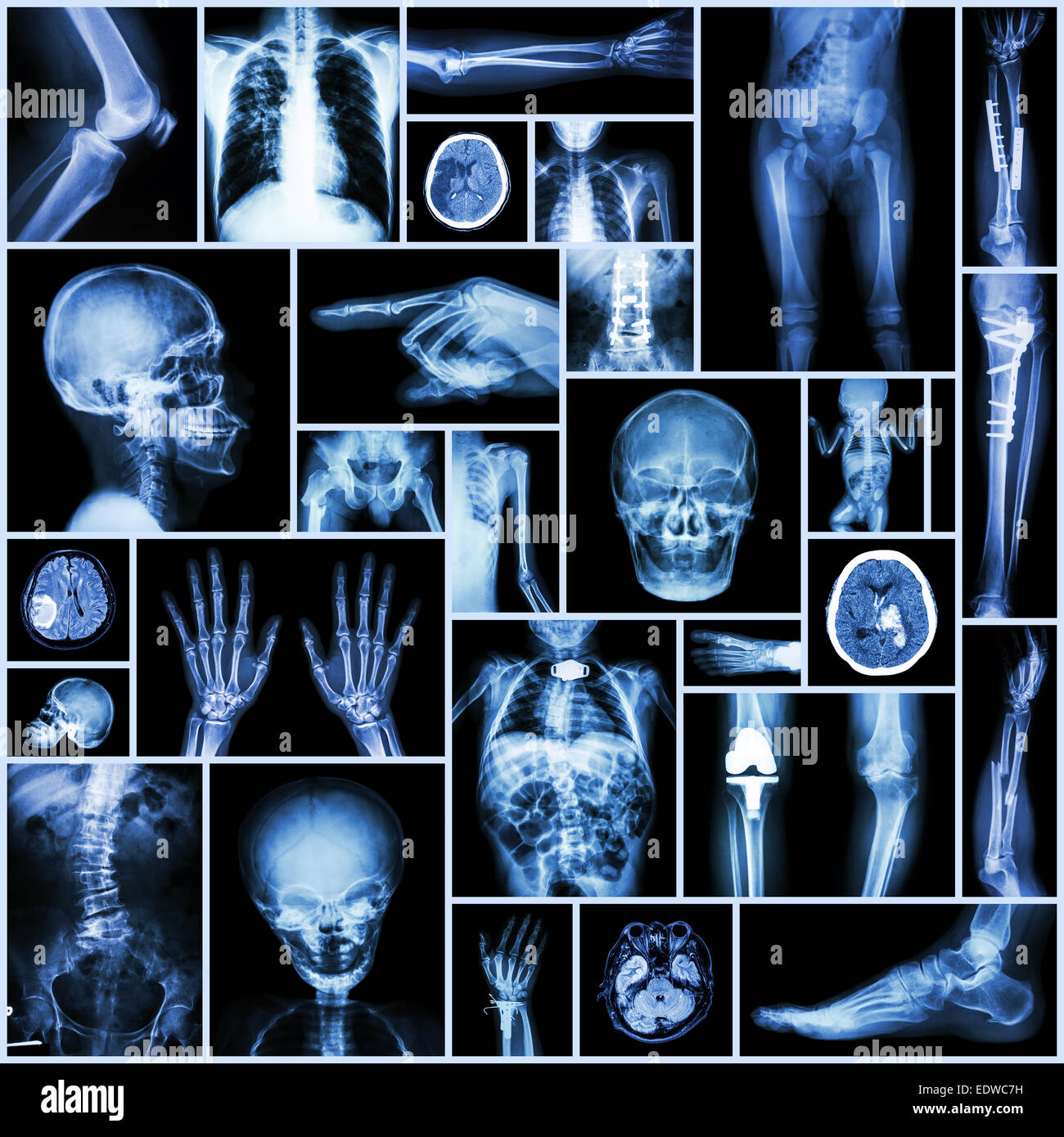 Kollektion x-ray Teil menschlichen, orthopädische Operation, mehrere Krankheiten (Fraktur, Gicht, rheumatoide Arthritis, Arthrose Knie, Str Stockfoto