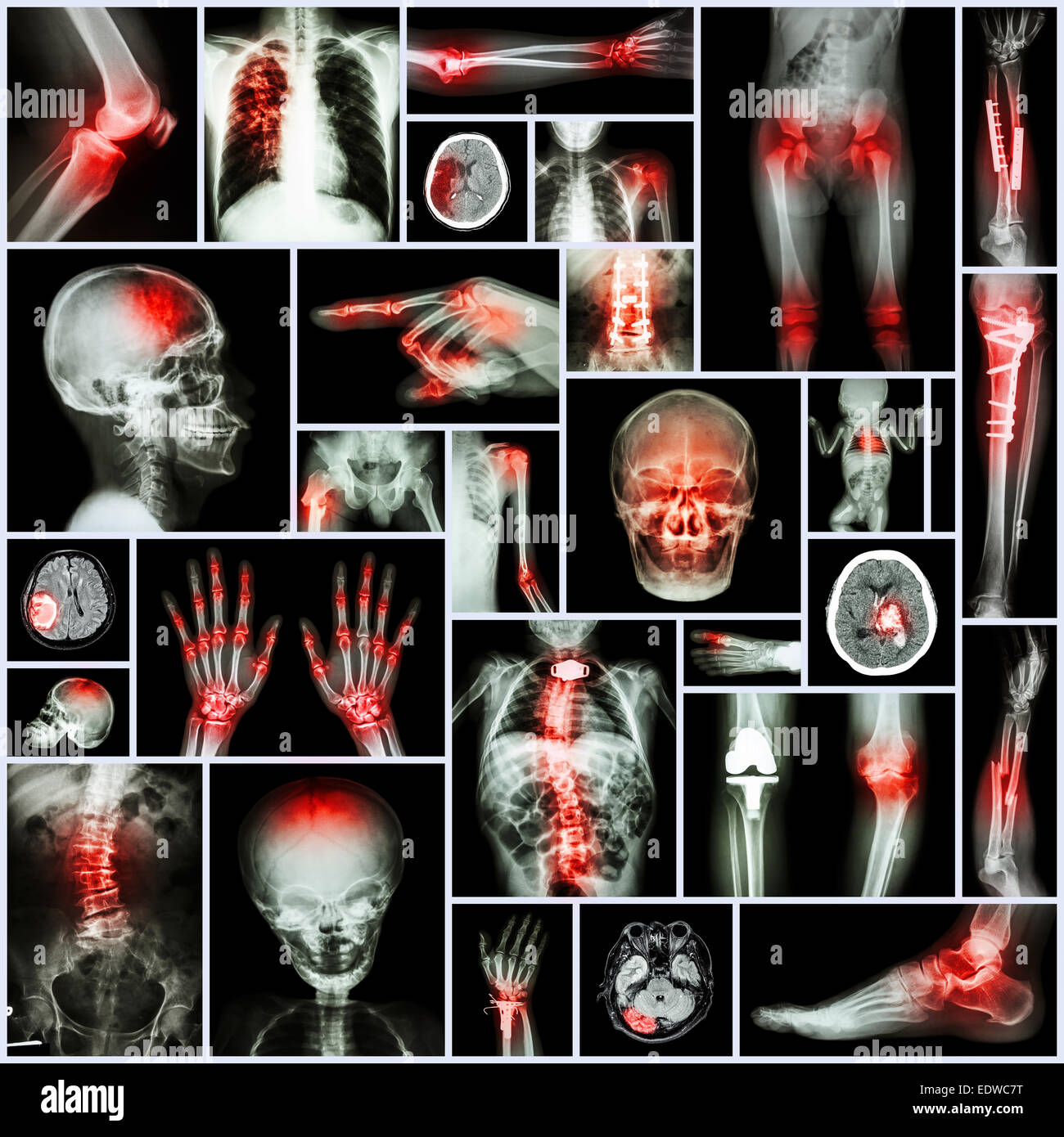 Kollektion x-ray Teil menschlichen, orthopädische Operation, mehrere Krankheiten (Fraktur, Gicht, rheumatoide Arthritis, Arthrose Knie, Str Stockfoto