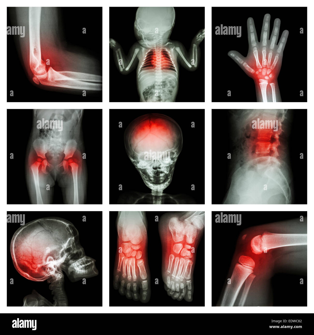 Kollektion x-ray Teil des Kindes und mehrere Verletzungen Stockfoto