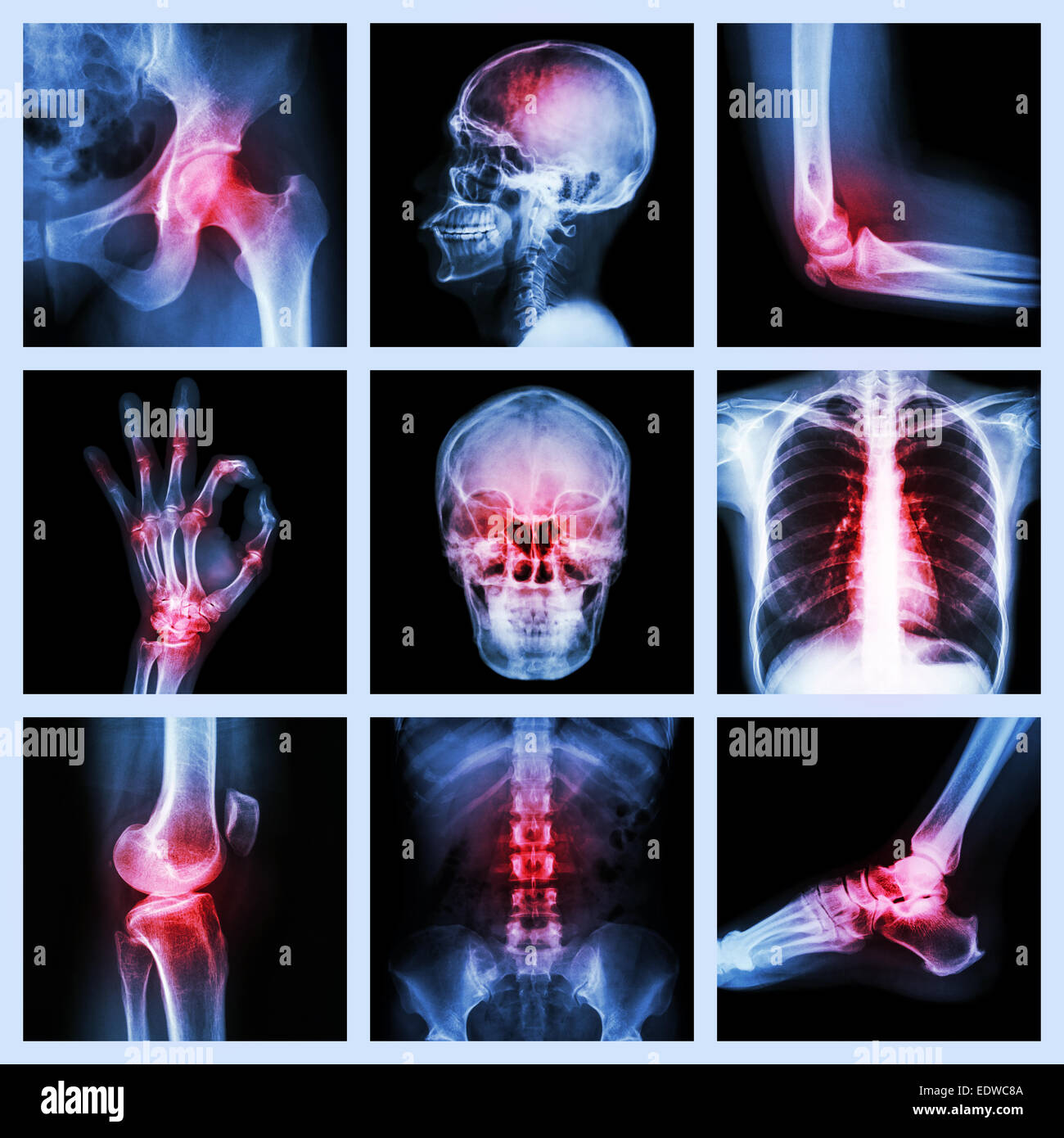 Kollektion Röntgen- und mehrere Verletzungen Stockfoto